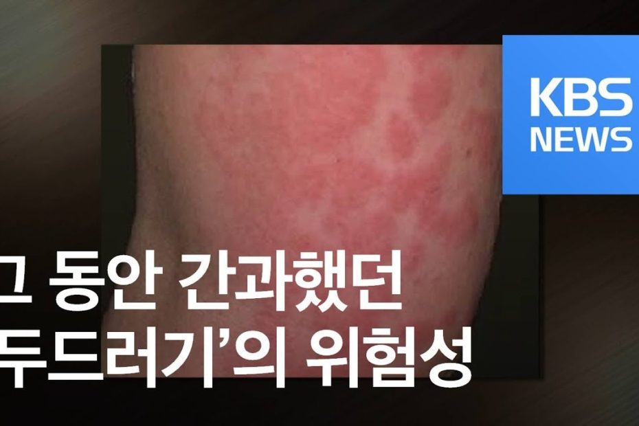 [5분 건강 톡톡] 부푸는 ‘두드러기’… 6주 이상 지속되면 ‘경고’ / KBS뉴스(News)